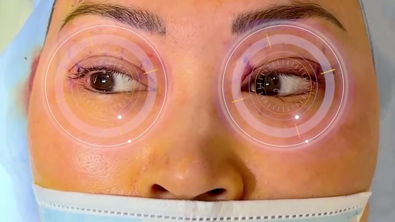 Ptosis & Double Eyelid Surgery: Precise Dissection Explained | Part 5