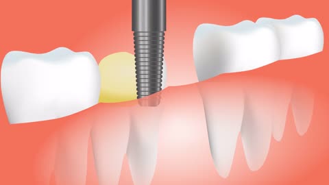 Tooth bridge medical dental care