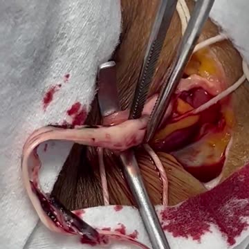 removing one of the strange white fibrous clots
