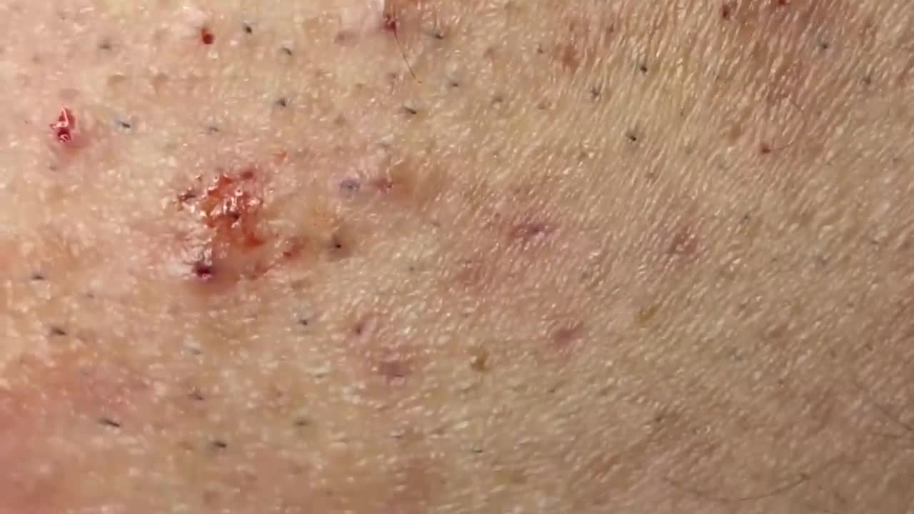 Removing Pimples and Blackheads from the Face, #4