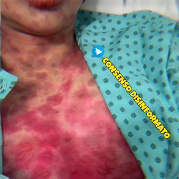 🇻🇳 TESTIMONIANZA EVENTI AVVERSI DOPO 💉MODERNA