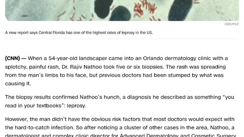 Curse of leprosy hitting Florida