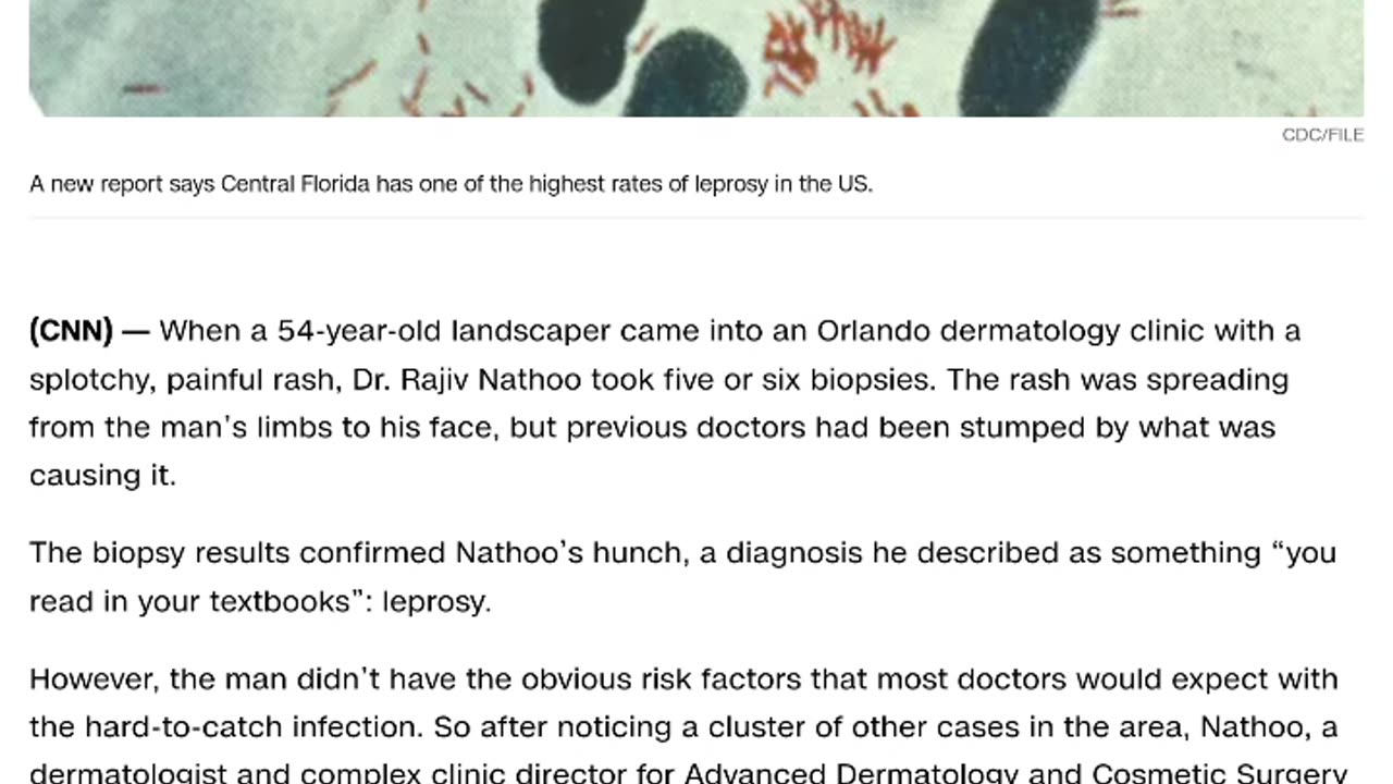 Curse of leprosy hitting Florida