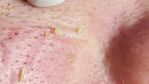 #131 | Acne Treatment Huong beauty