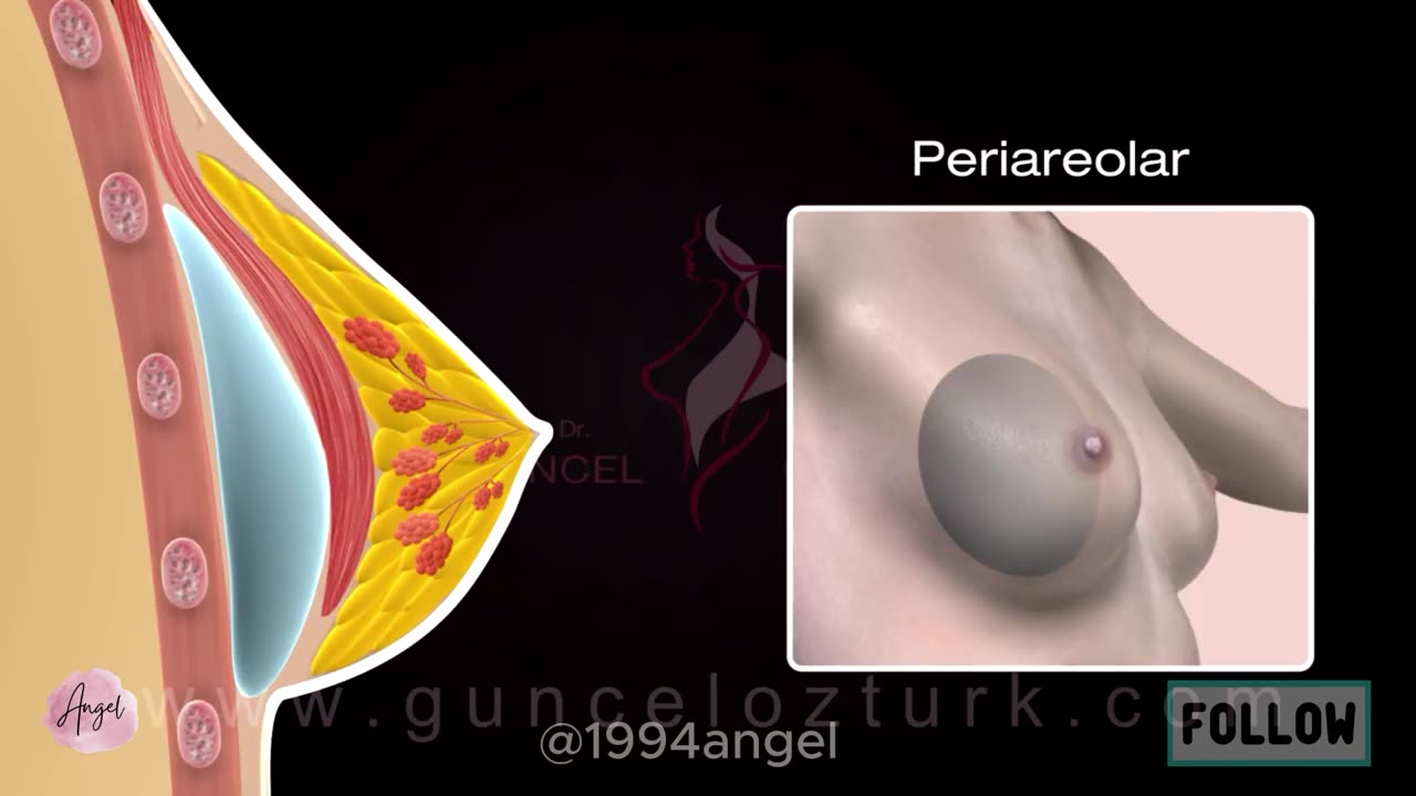 Breast Augmentation Surgery with Implants (3D Animation ) - Guncel Ozturk, MD - DRGO