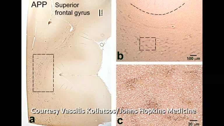 Hidden damage revealed in veterans' brains