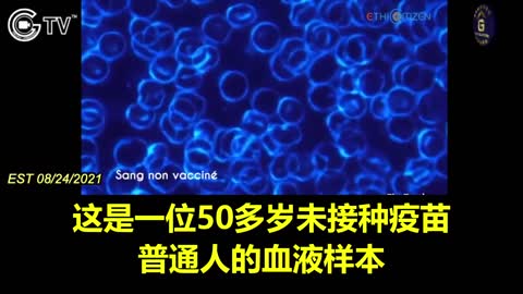 打疫苗後 紅血球都黏成一串了