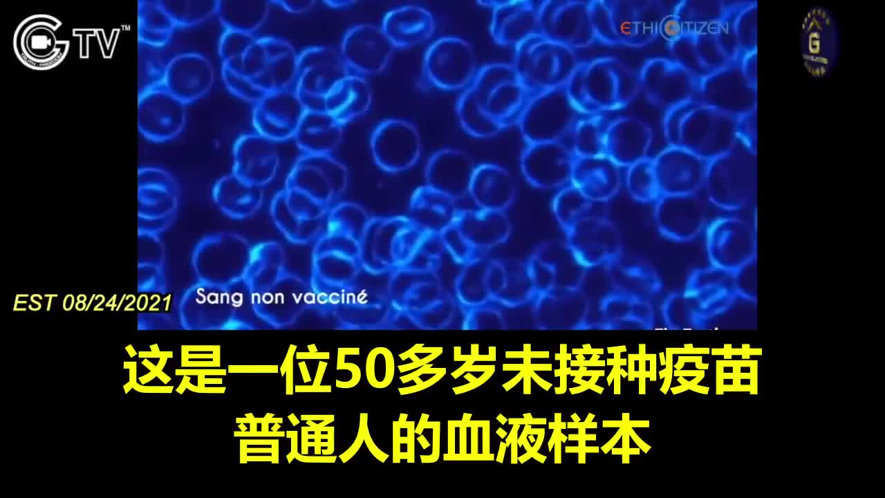 打疫苗後 紅血球都黏成一串了