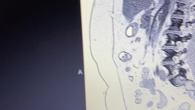 Epigastric hernia with intestines on exterior cavity wall