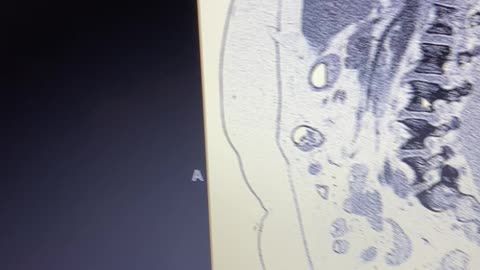 Epigastric hernia with intestines on exterior cavity wall