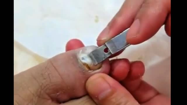 Removal of Big Ingrown Toe Nail ASMR Videos