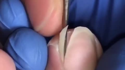 Stubborn Ingrown Removal