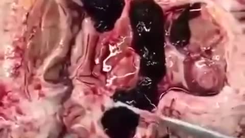 Massive blood clot found in brain of 💉 up