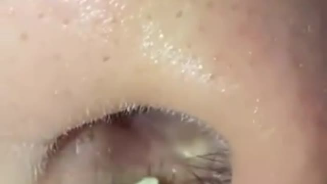 The Worst Gigantic Blackheads 2022&ComedoExtraction