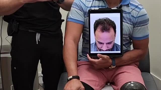 Mario Shares His Hair Transplant Results!