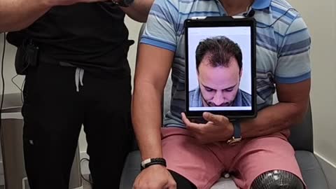 Mario Shares His Hair Transplant Results!