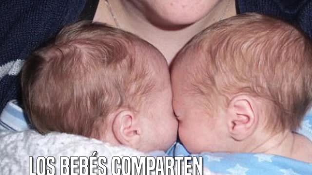 Theo y Reuben, los gemelos que desafiaron a la muerte con un abrazo