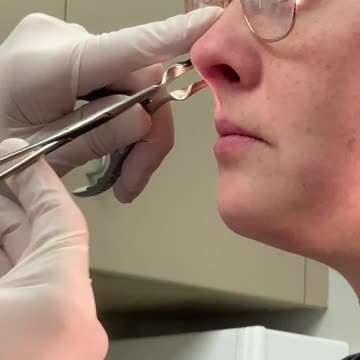 Post septum surgery removal.