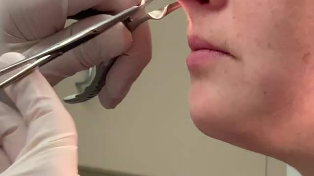 Post septum surgery removal.