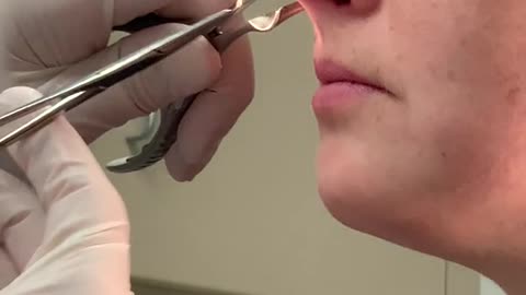 Post septum surgery removal.