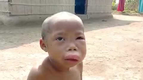 A Little boy bitten by bees in face.