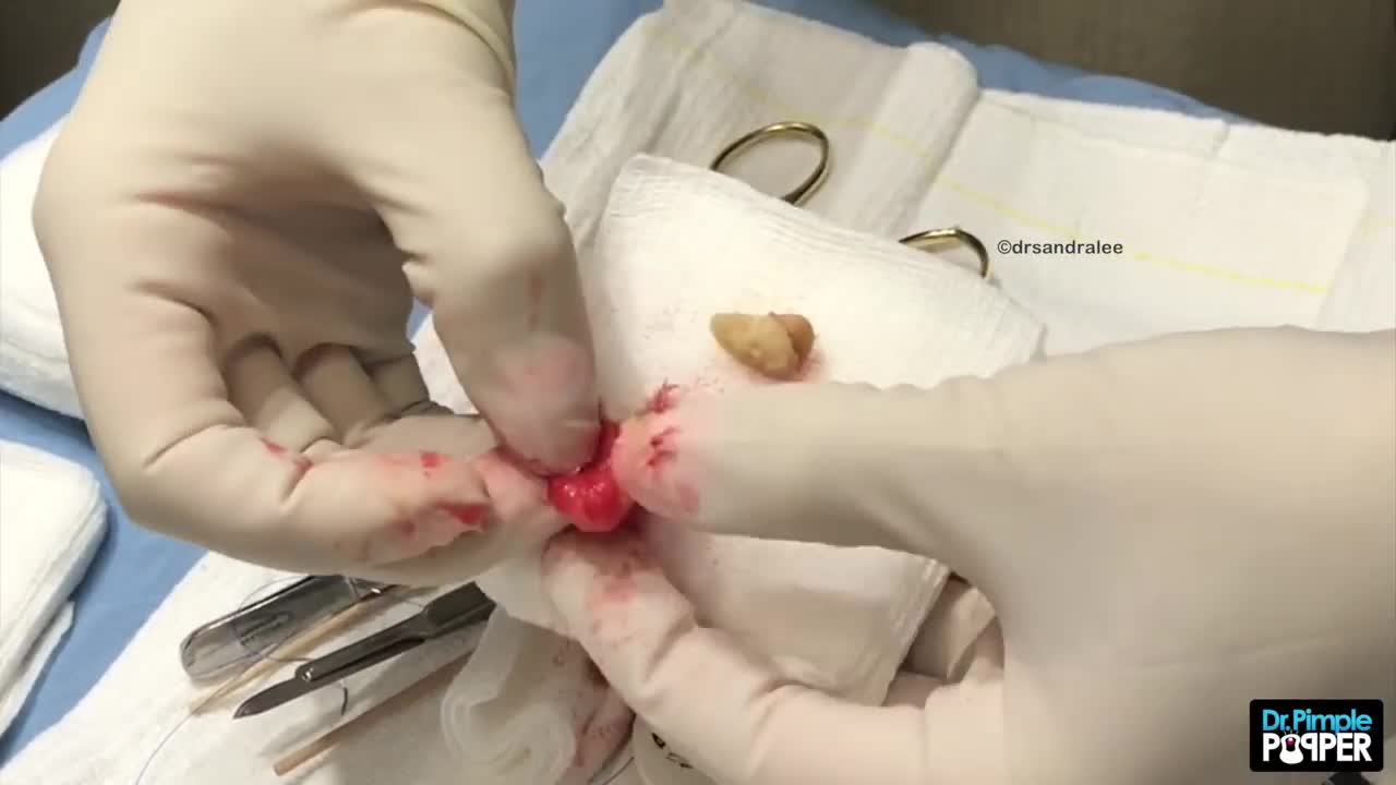 A Lima Bean Pilar Cyst