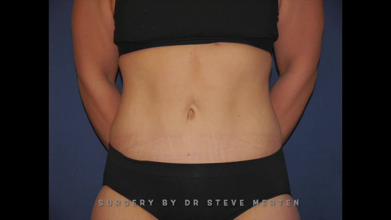 Body lift after Weight Loss - Before and After Morph Video