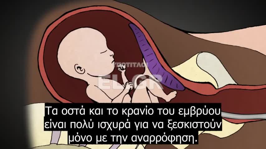 Χειρουργική έκτρωση 2ου τριμήνου_ Διαστολή και Εκκένωση