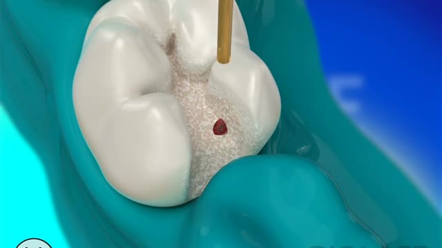 Dental Restoration with Waterlase Laser Dentistry - BIOLASE