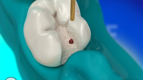 Dental Restoration with Waterlase Laser Dentistry - BIOLASE