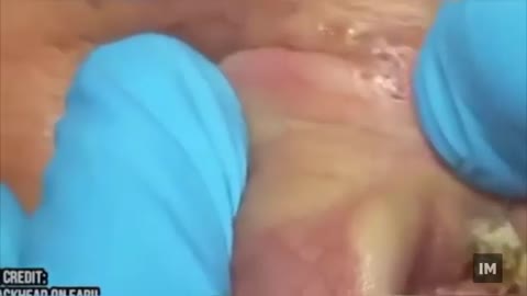 Gross Blackhead Removal Compilation