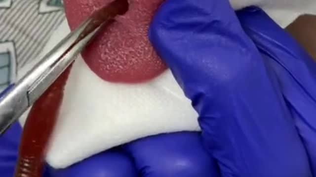 They pulled THAT from her TONGUE-!