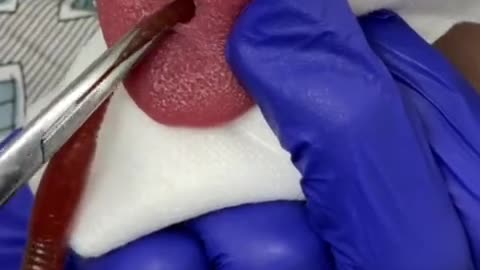 They pulled THAT from her TONGUE-!