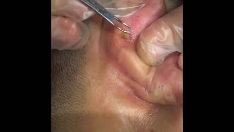 BIG pimple behind ear? is this the solution?