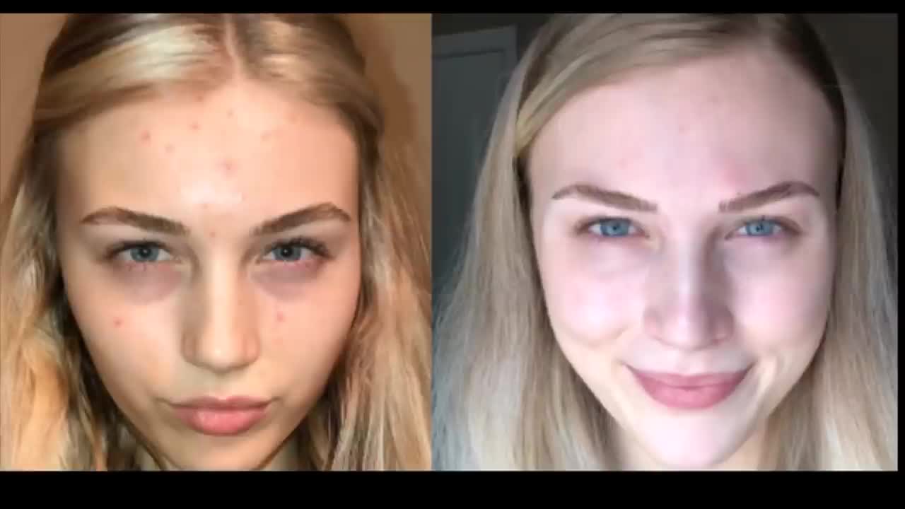 Ex Vegan Story From Makayla (4 Years Vegan, Acne, Stroke and Weakness)