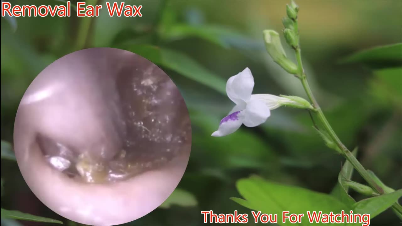 gigantic ear wax removal #16