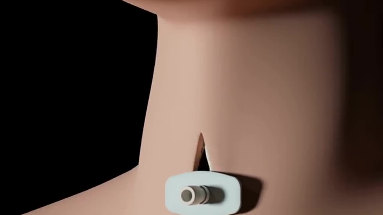 🖥3D animation of tracheostomy