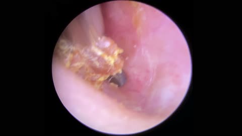 PART OF HEARING AID STUCK IN PATIENTS EAR