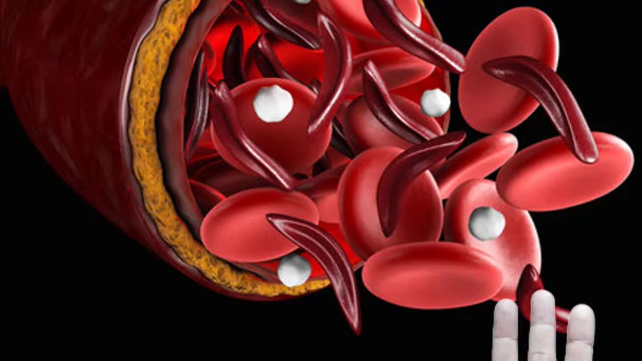 How to treat anemia problem by ancient hast mudra