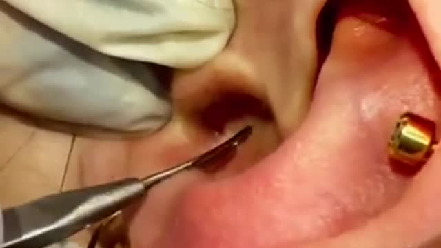 Blackhead Removal - Pimple popping - Acne Treatment - 01 -