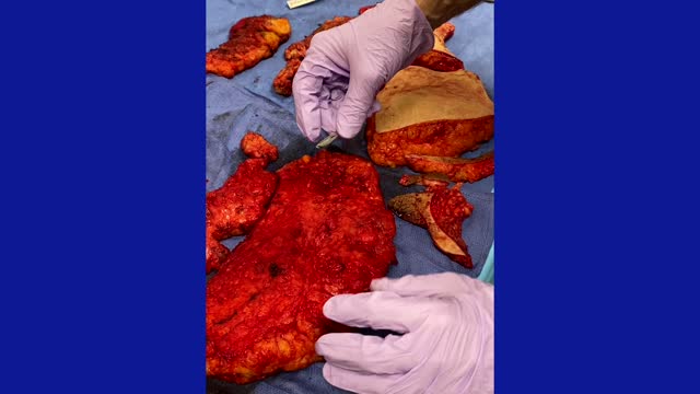 Plastic Surgery Procedure -- Excision of Silicone in Buttocks with an InfraGluteal Posterior Buttock Lift