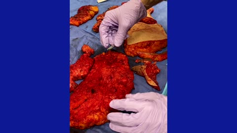 Plastic Surgery Procedure -- Excision of Silicone in Buttocks with an InfraGluteal Posterior Buttock Lift