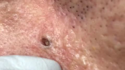 Big blackhead
