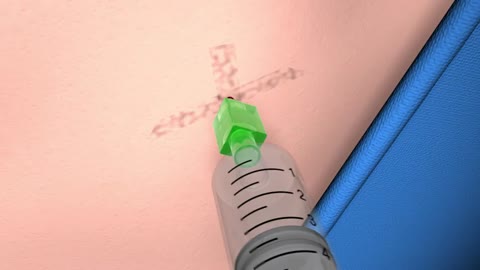 Insertion of intercostal drain Seldinger technique animated demonstration