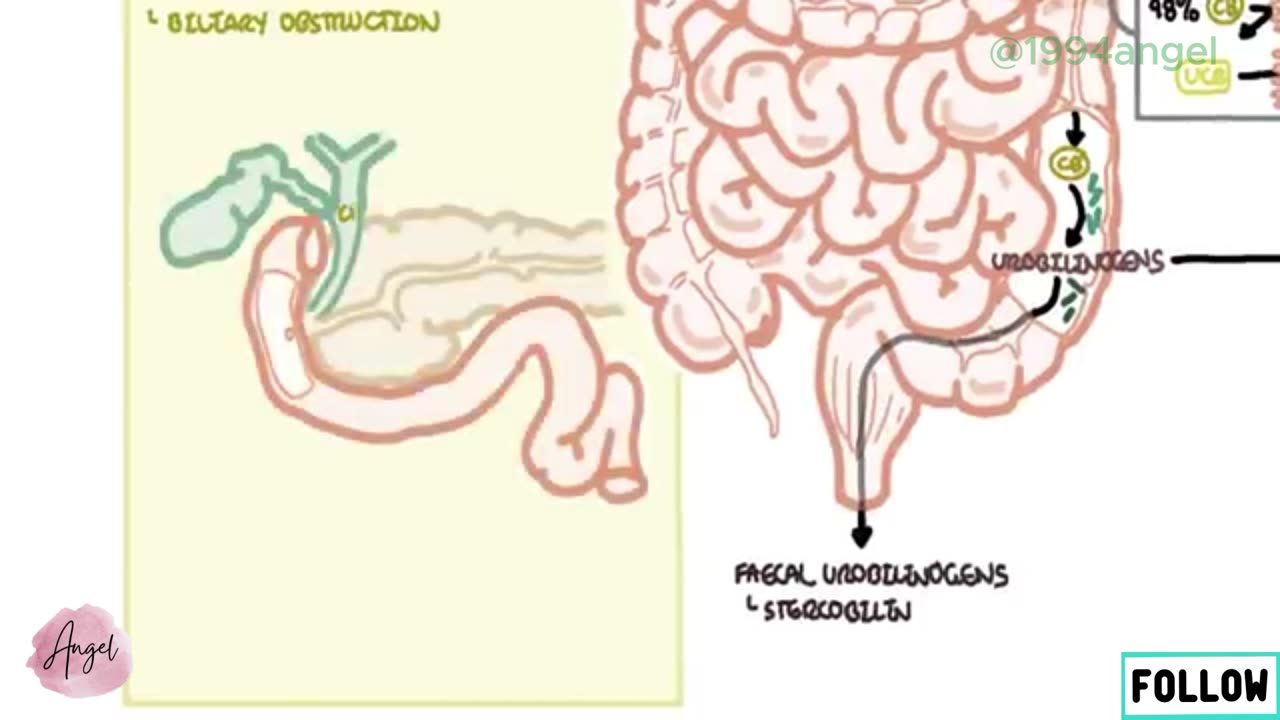 Approach to Jaundice - types and causes of hyperbilirubinemia, investigations