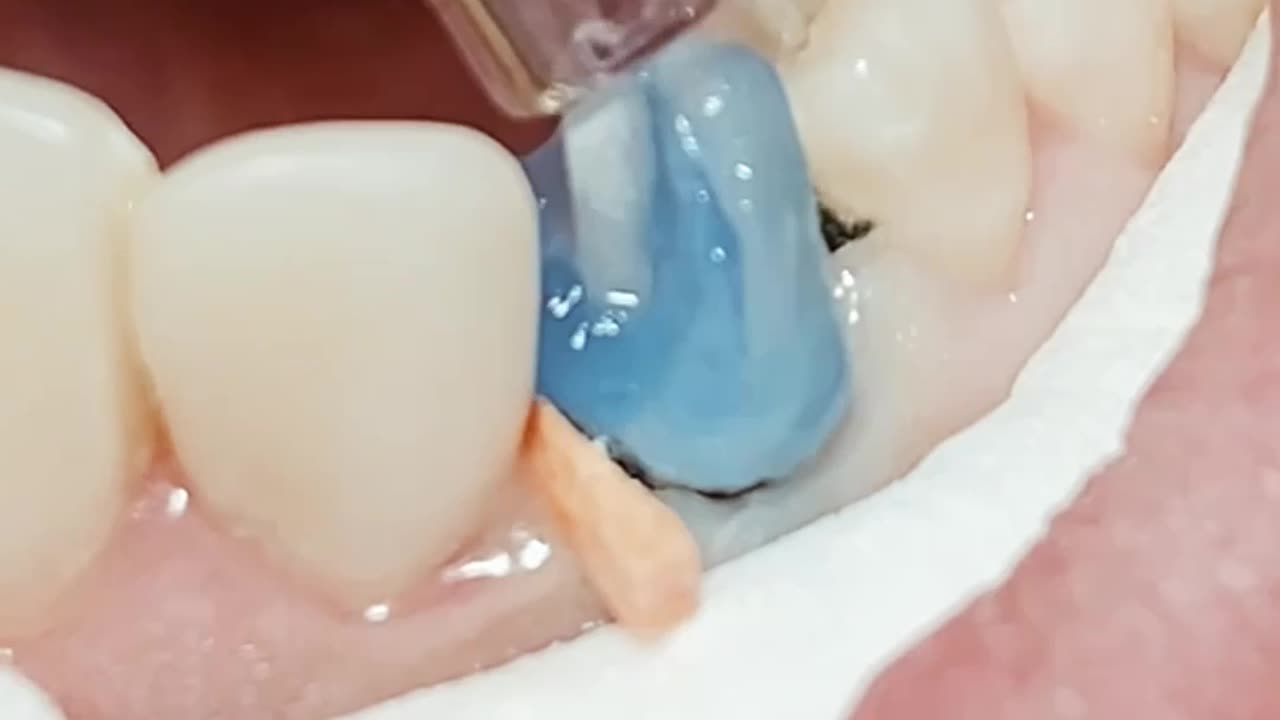 Tooth Fiber post & composite