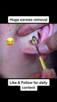 Pimple Popping Acne Treatment Blackhead Extraction