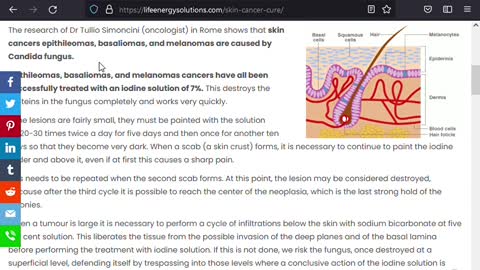 Treating Skin Cancer with Iodine