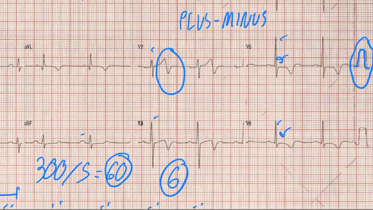 Discussão de ecg - Síndrome de Wellens