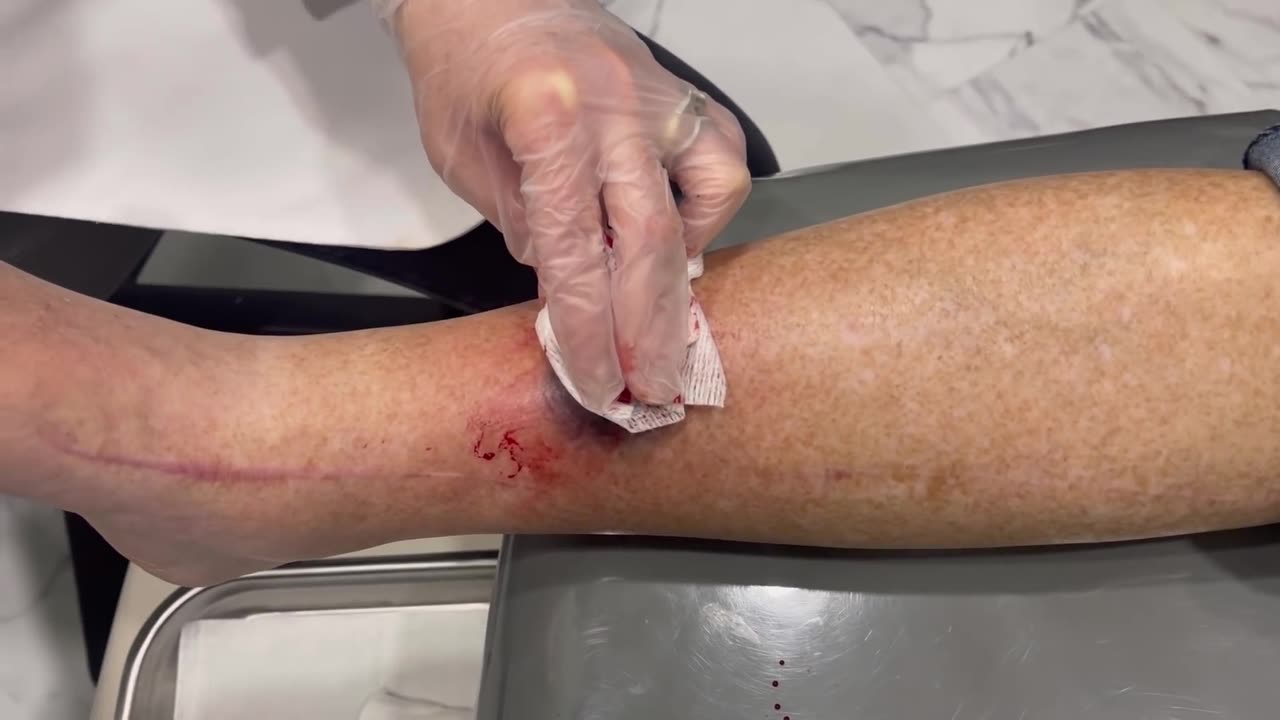 Huge Hematoma on Leg